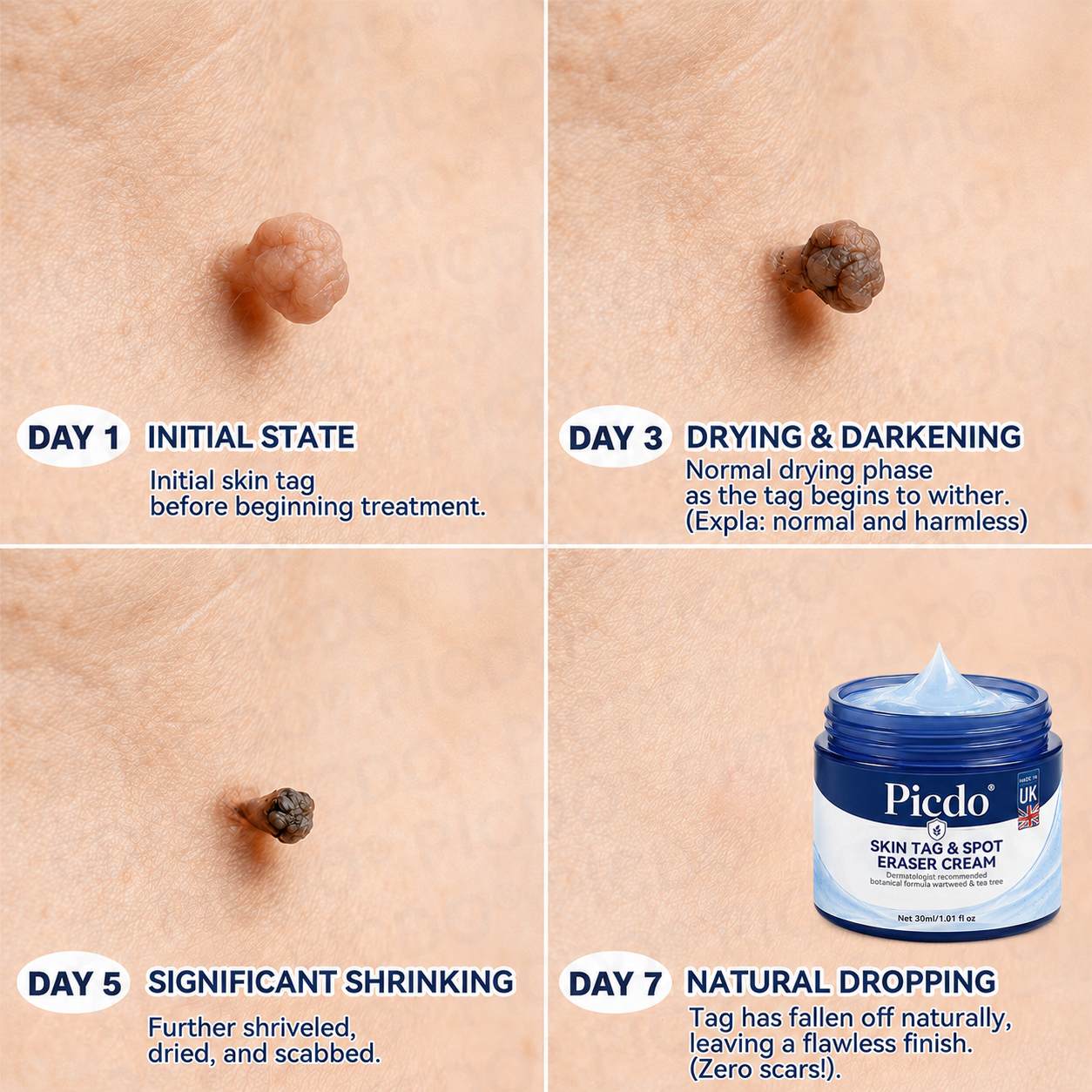 🍀𝐏𝐢𝐜𝐝𝐨® 7-𝐃𝐚𝐲 𝐒𝐤𝐢𝐧 𝐓𝐚𝐠 & 𝐒𝐩𝐨𝐭 𝐄𝐫𝐚𝐬𝐞𝐫 𝐂𝐫𝐞𝐚𝐦 (Zero Pain, Zero 𝐒𝐜𝐚𝐫𝐬 Formula) 💯
