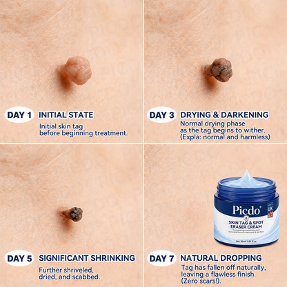 🍀𝐏𝐢𝐜𝐝𝐨® 7-𝐃𝐚𝐲 𝐒𝐤𝐢𝐧 𝐓𝐚𝐠 & 𝐒𝐩𝐨𝐭 𝐄𝐫𝐚𝐬𝐞𝐫 𝐂𝐫𝐞𝐚𝐦 (Zero Pain, Zero 𝐒𝐜𝐚𝐫𝐬 Formula) 💯