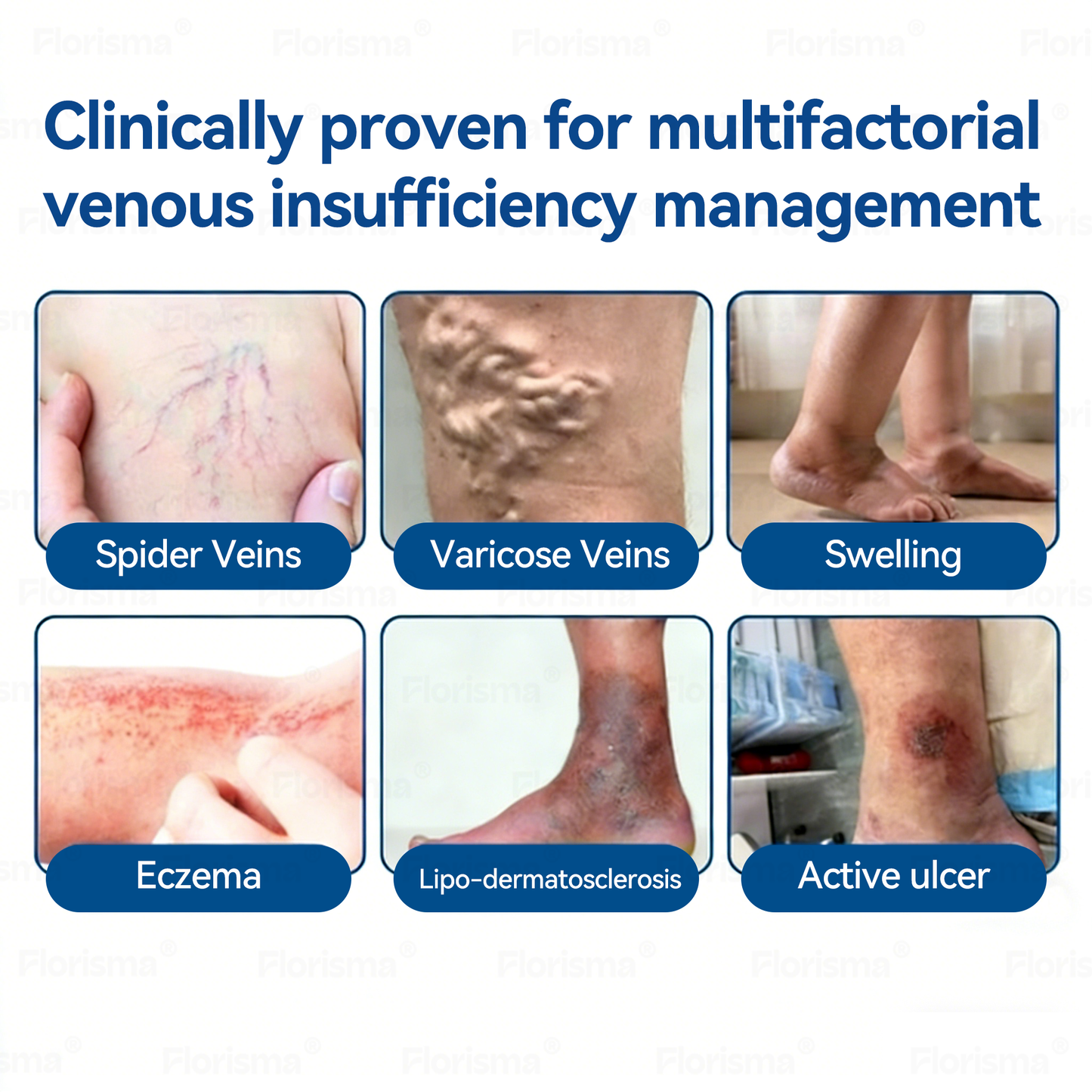 ✨👍𝐅𝐥𝐨𝐫𝐢𝐬𝐦𝐚® 𝐕𝐞𝐢𝐧𝐓𝐚𝐫𝐠𝐞𝐭 𝐌𝐢𝐜𝐫𝐨𝐧𝐞𝐞𝐝𝐥𝐞 𝐏𝐚𝐭𝐜𝐡⚡ —An advanced blend of plant-based ingredients to help target spider veins and varicose veins, while relieving heavy, tired legs.