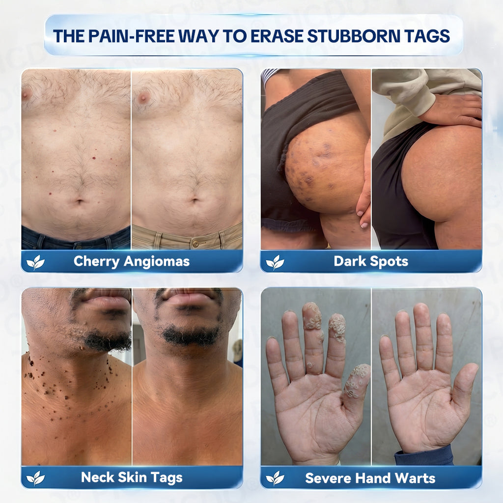 🍀𝐏𝐢𝐜𝐝𝐨® 7-𝐃𝐚𝐲 𝐒𝐤𝐢𝐧 𝐓𝐚𝐠 & 𝐒𝐩𝐨𝐭 𝐄𝐫𝐚𝐬𝐞𝐫 𝐂𝐫𝐞𝐚𝐦 (Zero Pain, Zero 𝐒𝐜𝐚𝐫𝐬 Formula) 💯