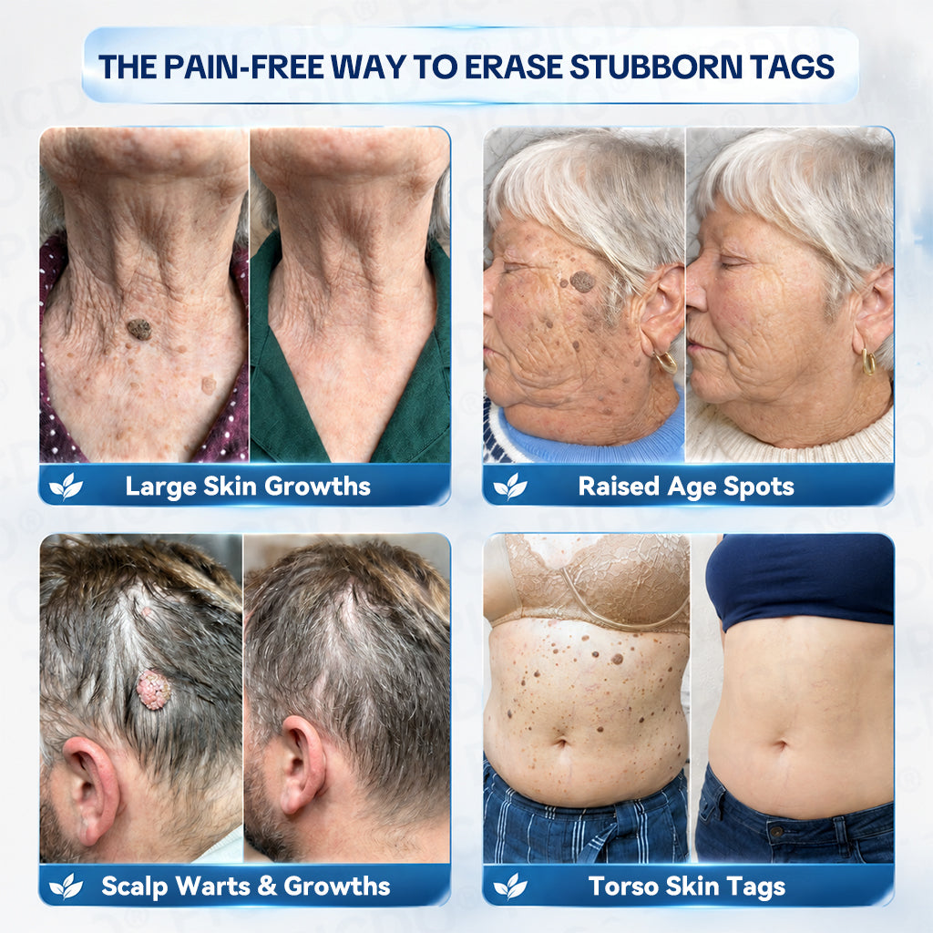 🍀𝐏𝐢𝐜𝐝𝐨® 7-𝐃𝐚𝐲 𝐒𝐤𝐢𝐧 𝐓𝐚𝐠 & 𝐒𝐩𝐨𝐭 𝐄𝐫𝐚𝐬𝐞𝐫 𝐂𝐫𝐞𝐚𝐦 (Zero Pain, Zero 𝐒𝐜𝐚𝐫𝐬 Formula) 💯